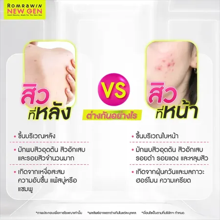 สิวที่หลัง