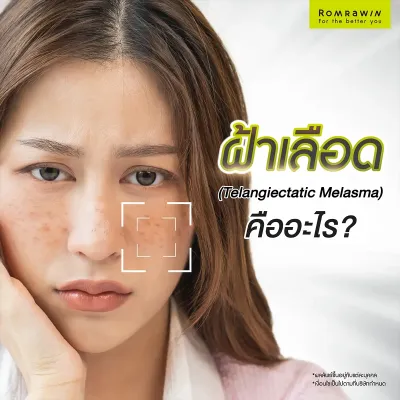ฝ้าเลือดคืออะไร เกิดจากอะไร รักษายังไงให้หาย