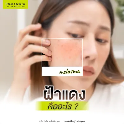 ฝ้าแดง คืออะไร สาเหตุเกิดจากอะไร มีวิธีดูแลรักษาอย่างไร