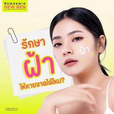 รักษาฝ้าให้หายขาด ฝ้าดูจางลง แบบธรรมชาติและเร่งด่วน  มีวิธีอย่างไร