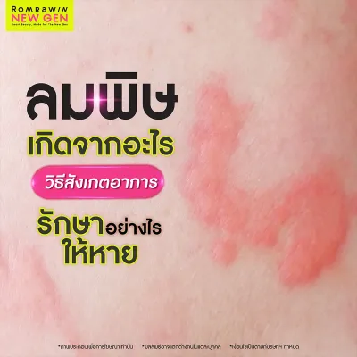 ลมพิษ คืออะไร? เช็กสาเหตุ อาการ และวิธีรักษาให้หายไว