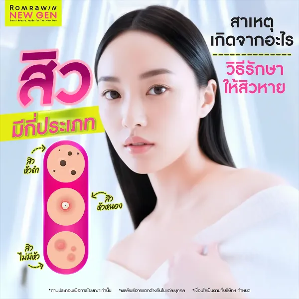 สิวมีกี่ประเภท? เจาะลึกสาเหตุและวิธีรักษาให้หน้าใส ไร้สิว