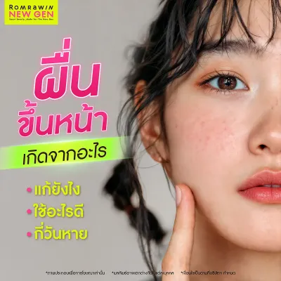 ผื่นขึ้นหน้าเกิดจากอะไร? เช็ก 10 สาเหตุยอดฮิต พร้อมวิธีแยกประเภทผื่น