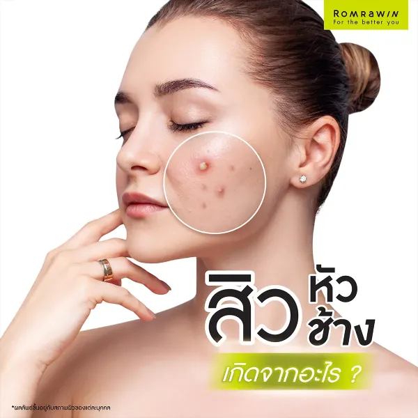 สิวหัวช้าง คืออะไร เกิดจากสาเหตุอะไร รักษาอย่างไรให้สิวยุบ