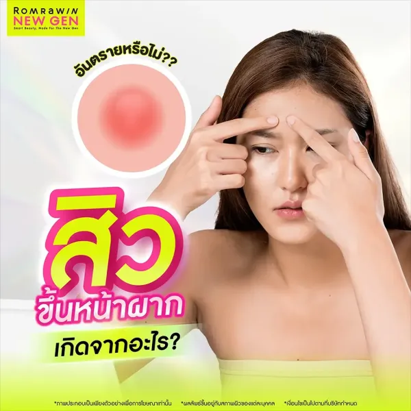 สิวขึ้นหน้าผาก เกิดจากอะไร วิธีรักษาอย่างตรงจุด เหมาะกับใคร