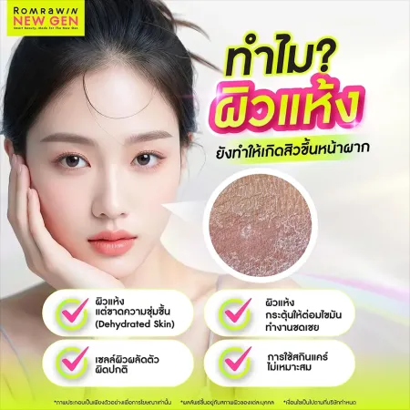 ทำไมผิวแห้งเป็นสิวขึ้นหน้าผาก สาเหตุผิวขาดน้ำเกิดสิวอุดตัน