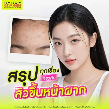 สรุปทุกเรื่องสิวขึ้นหน้าผาก สาเหตุและแนวทางรักษาโดยแพทย์