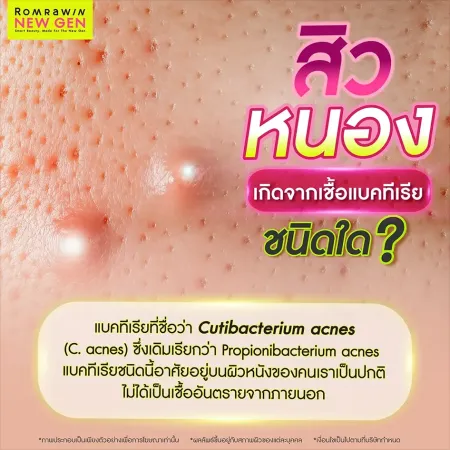 สิวหนองเกิดจาก