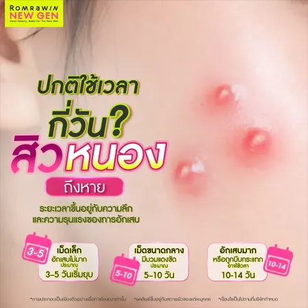 สิวหนองเกิดจาก