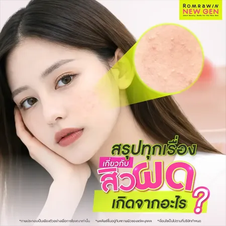 สิวผดเกิดจาก