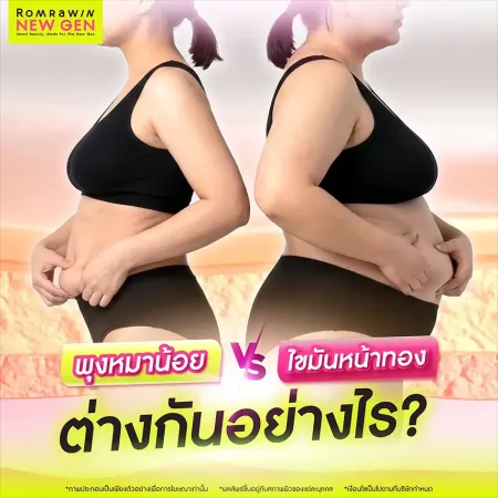 พุงหมาน้อย VS ไขมันหน้าทอง ต่างกันอย่างไร ภาพกราฟิกเปรียบเทียบลักษณะพุงส่วนล่างยื่นนูนกับไขมันสะสมรอบเอวหนา
