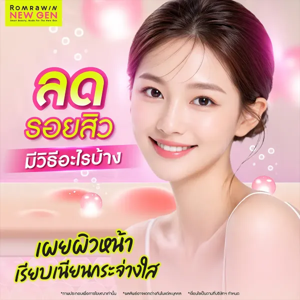 ลดรอยสิว มีวิธีอะไรบ้าง? ทั้งสกินแคร์และเลเซอร์ปี 2026