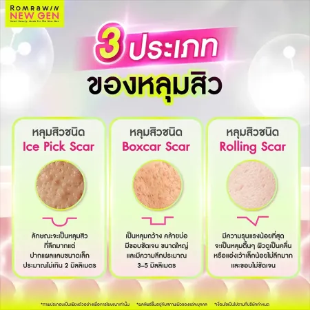 หลุมสิว