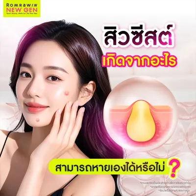 สิวซีสต์คืออะไร? สาเหตุ อาการ และวิธีรักษาที่ถูกต้อง