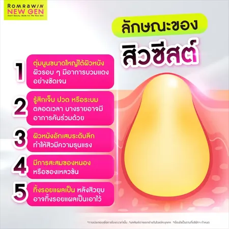 ลักษณะสิวซีสต์ 5 อาการ พร้อมภาพตัดขวางก้อนสิวอักเสบลึกใต้ผิวหนัง