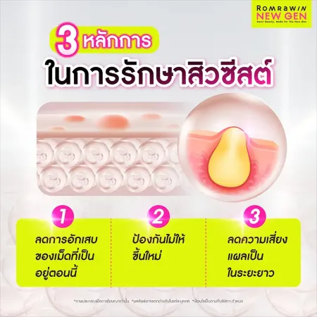 3 หลักการรักษาสิวซีสต์ ลดการอักเสบ ป้องกันการเกิดสิวใหม่ และลดความเสี่ยงแผลเป็นระยะยาว