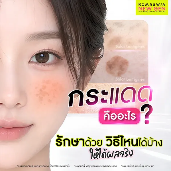 กระแดดคืออะไร? สาเหตุ วิธีรักษา และการป้องกันที่ได้ผลจริง