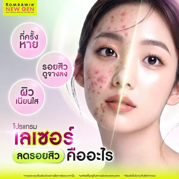 เลเซอร์ลดรอยสิว คืออะไร? หน้าใส ไร้จุดด่างดำเห็นผลไว