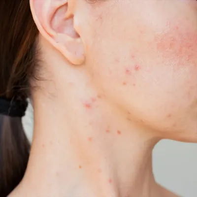 สิวขึ้นที่คอเกิดจากอะไร? สาเหตุและวิธีรักษาที่ถูกต้อง