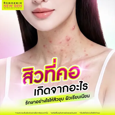 สิวขึ้นที่คอเกิดจากอะไร? สาเหตุและวิธีรักษาที่ถูกต้อง