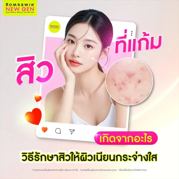 สิวที่แก้มเกิดจากอะไร? วิธีรักษายังไง ให้สิวหายขาด