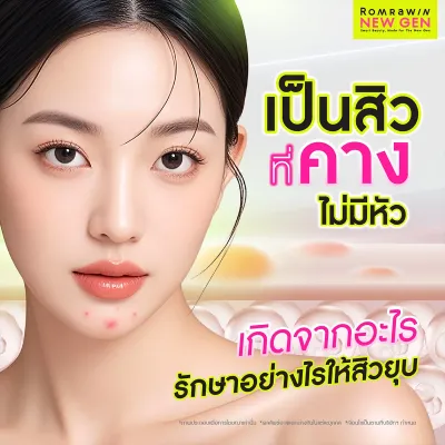 เป็นสิวที่คาง ไม่มีหัว เกิดจากอะไร? สาเหตุและวิธีรักษา