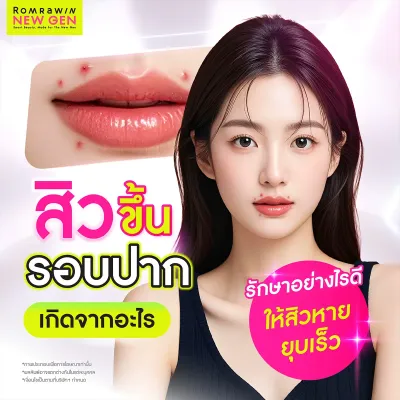 สิวขึ้นรอบปากเกิดจากอะไร? สาเหตุและวิธีรักษาให้หายขาด