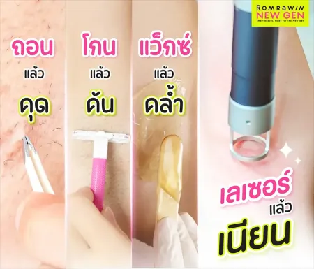 เลเซอร์ขน
