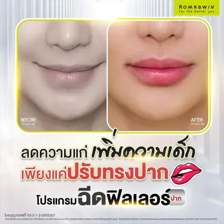 ฟิลเลอร์ปาก