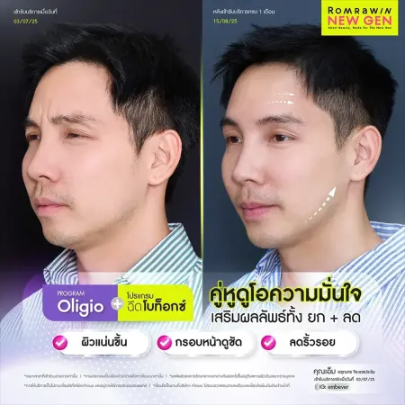 รีวิว PROGRAM Oligio คู่หูโอความมั่นใจ เสริมผลลัพธ์ทั้ง ยก ลด ภาพเคสรีวิวเปรียบเทียบก่อนและหลังทำปรับกรอบหน้าคมชัดของผู้ชาย