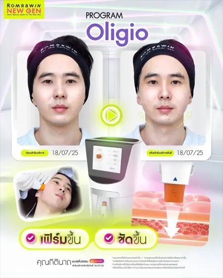 รีวิว PROGRAM Oligio เฟิร์มขึ้น ชัดขึ้น ภาพเคสรีวิวผู้ชายเปรียบเทียบก่อนและหลังทำยกกระชับใบหน้าปรับกรอบหน้าให้คมชัด
