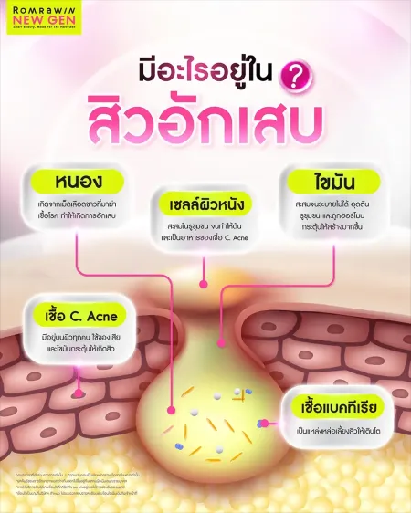 สิวฮอร์โมน