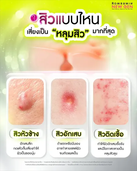 สิวแบบไหนเสี่ยงเป็นหลุมสิวมากที่สุด ทั้งสิวหัวช้าง สิวอักเสบ และสิวติดเชื้อ
