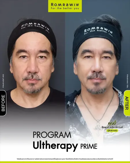 รีวิว Ultherapy Prime ก่อนหลังทำ คุณบี๋ ธีรพงศ์ ยกกระชับหน้าผู้ชาย