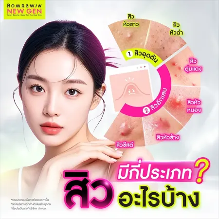 จำแนกประเภทสิวชนิดต่างๆ ทั้งสิวอุดตันและสิวอักเสบ เพื่อการรักษาตรงจุด