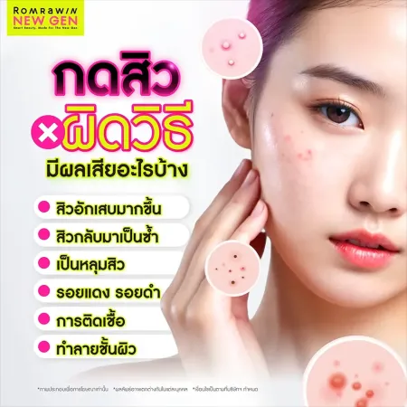 เช็กผลเสียของการกดสิวผิดวิธี เสี่ยงสิวอักเสบ ติดเชื้อ และเกิดหลุมสิว