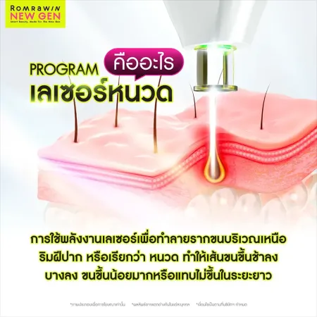 ภาพกราฟิกอธิบายการทำงานของเลเซอร์หนวดรมย์รวินท์นิวเจนแสดงชั้นผิวและลำแสงเลเซอร์ที่ส่งพลังงานลงไปทำลายรากขนบริเวณเหนือริมฝีปาก