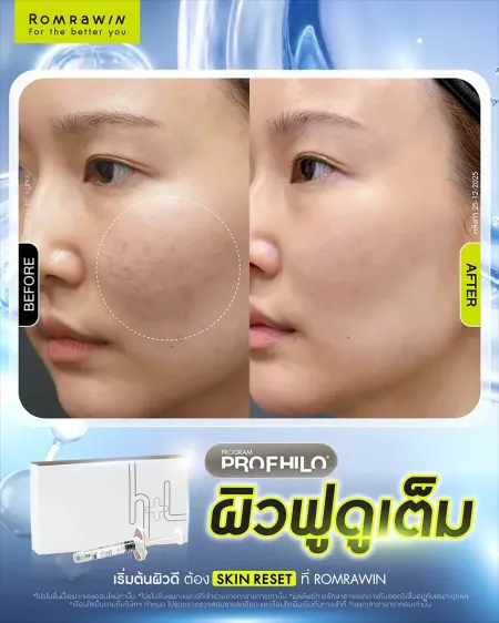 ภาพเปรียบเทียบก่อนและหลังทำ Program Profhilo ผิวฟูดูเต็ม