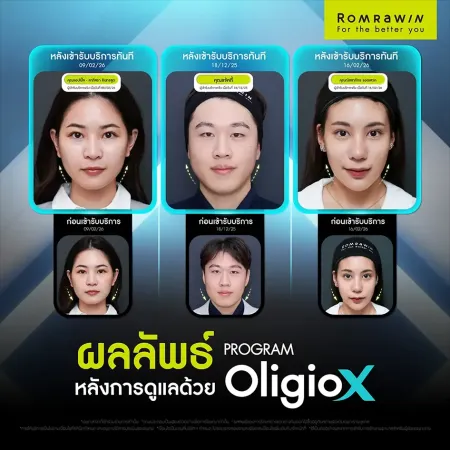 ภาพเปรียบเทียบผลลัพธ์ก่อนหลังทำ Oligio X จากเคสรีวิวผู้ใช้บริการจริง
