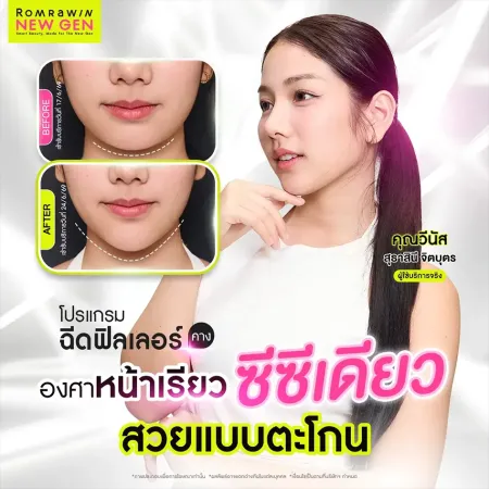 ผลลัพธ์ฉีดฟิลเลอร์คาง 1 cc ปรับองศาหน้าเรียว Before After คุณวีนัส