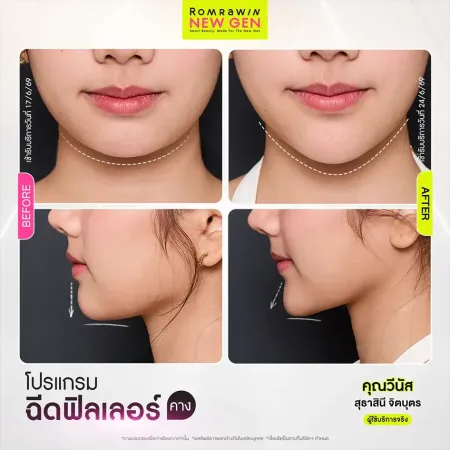 ภาพเปรียบเทียบก่อนหลังทำโปรแกรมฉีดฟิลเลอร์คาง คุณวีนัส