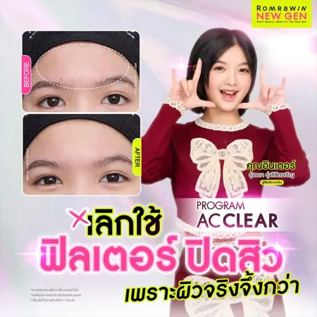 รีวิว AC Clear รักษาสิว คุณอินเตอร์ รุ่งรดา หน้าเรียบเนียน