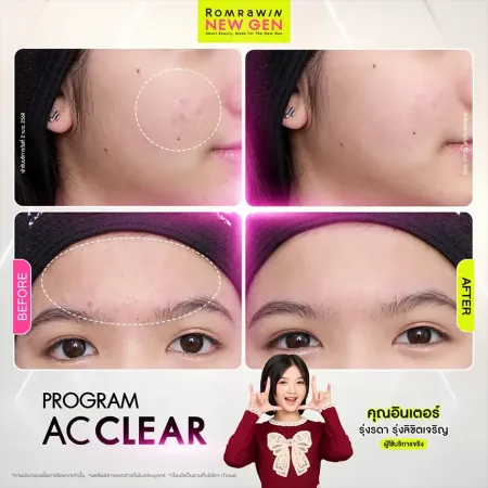 รีวิว AC Clear รักษาสิวแก้มและหน้าผาก คุณอินเตอร์ รุ่งรดา
