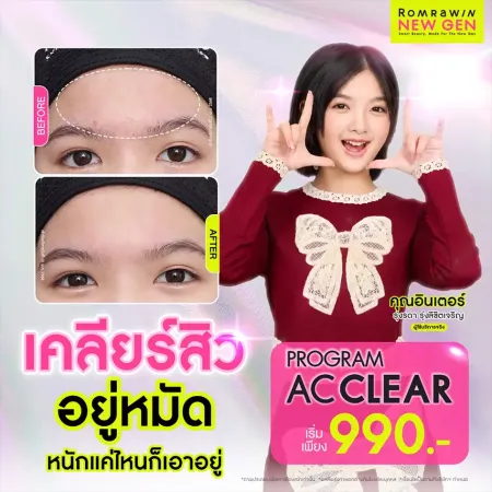 รีวิวรักษาสิว AC Clear คุณอินเตอร์ รุ่งรดา เคลียร์สิวหน้าผาก