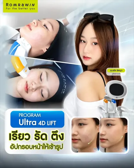 รีวิวเคสคนไข้จริงก่อนและหลังทำหัตถการยกกระชับกรอบหน้าด้วยโปรแกรม Ultraformer รมย์รวินท์คลินิก