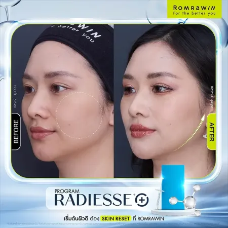 รีวิว Radiesse Romrawin เคสผู้ใช้บริการจริงเปรียบเทียบผิวหน้าก่อนและหลังทำโปรแกรมปรับรูปหน้าแก้ม