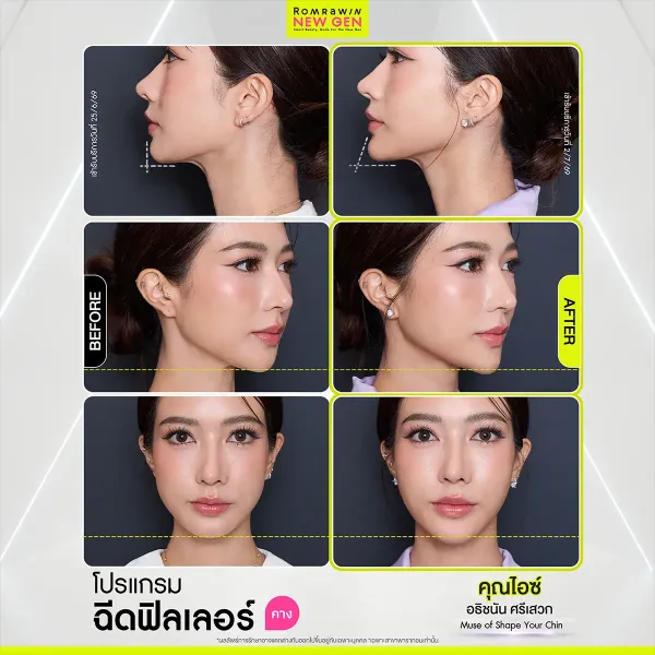 รีวิวฉีดฟิลเลอร์คาง คุณไอซ์ คางสวยหน้าเรียวเป็นธรรมชาติ