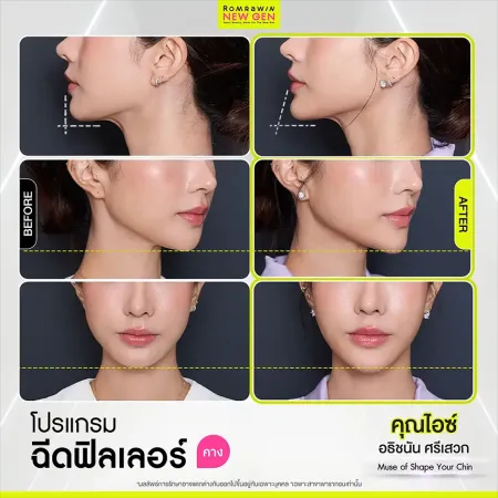 รีวิวฟิลเลอร์คาง เคสคุณไอซ์ภาพเปรียบเทียบก่อนหลังทำโปรแกรมปรับรูปหน้าเพื่อปรับทรงคางให้ดูยาวสมส่วนได้รูป