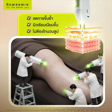 วิธีกำจัดขนขาด้วยเลเซอร์ ชะลอการขึ้นซ้ำ ปรับผิวเรียบเนียน ไม่ต้องโกนวนลูป