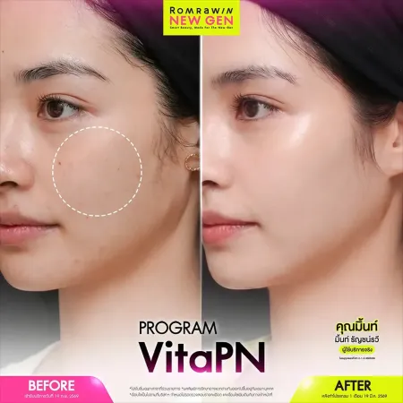 Vita PN (Vitaran) รีวิวเปรียบเทียบผิวหน้าก่อนและหลังทำโปรแกรมฟื้นฟูผิวที่ช่วยลดรอยสิวและปรับจุดด่างดำแก้มใส